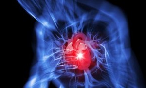 infarto