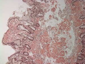 800px-Small_bowel_duodenum_with_amyloid_deposition_congo_red_10X